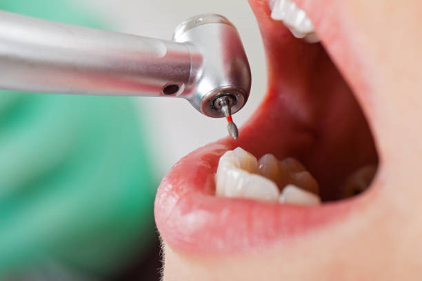 Best Broken or Cracked Tooth Emergency Dentist in Destin, FL